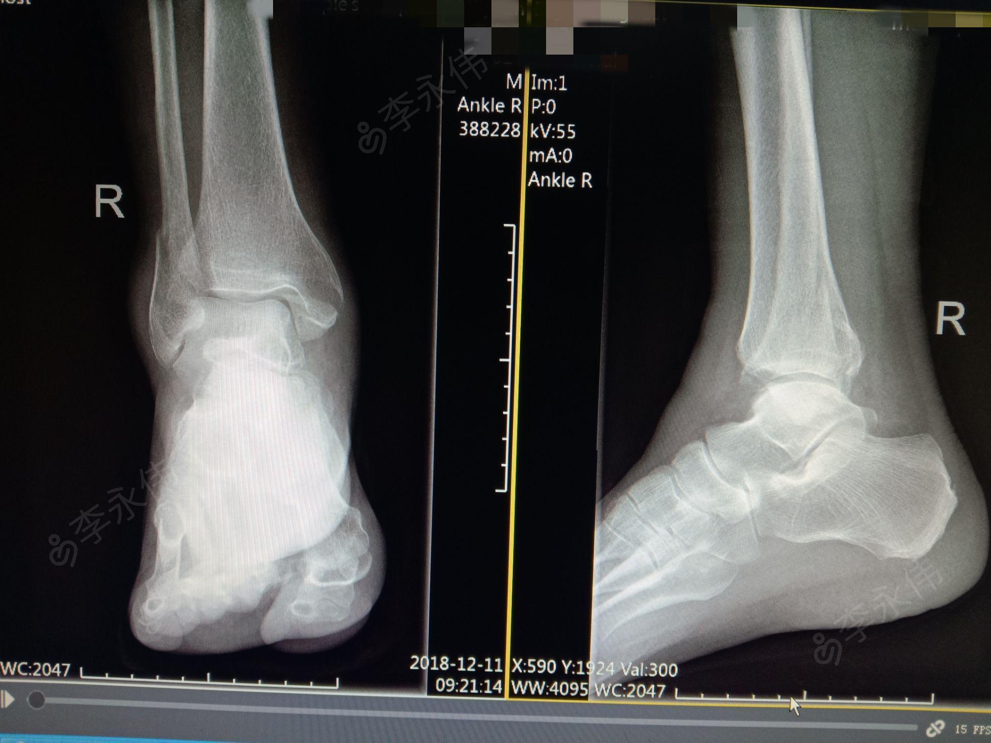 左内外后踝骨折、左踝半脱位；左跟骨及足舟骨骨折。