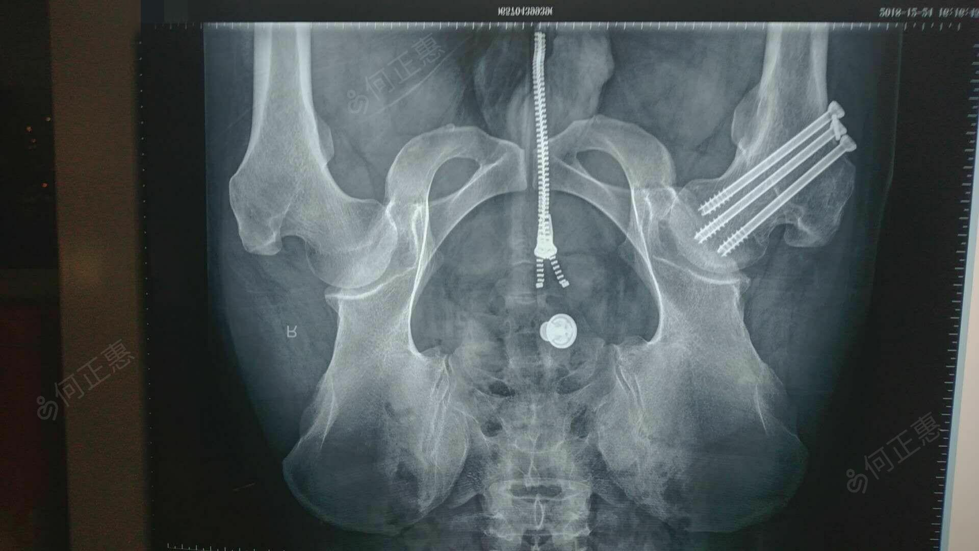 股骨颈骨折注定要人工关节置换？