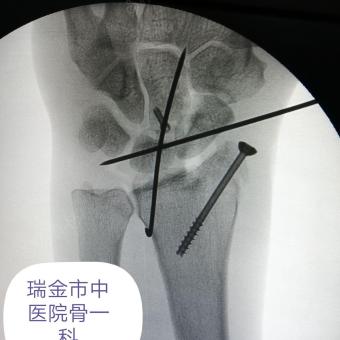 腕舟骨月骨脱位合并头状骨桡骨茎突骨折