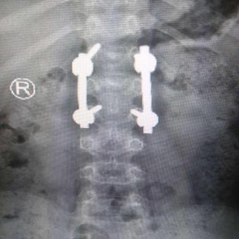 患者伤口愈合良好,腰椎活动可,内固定在位