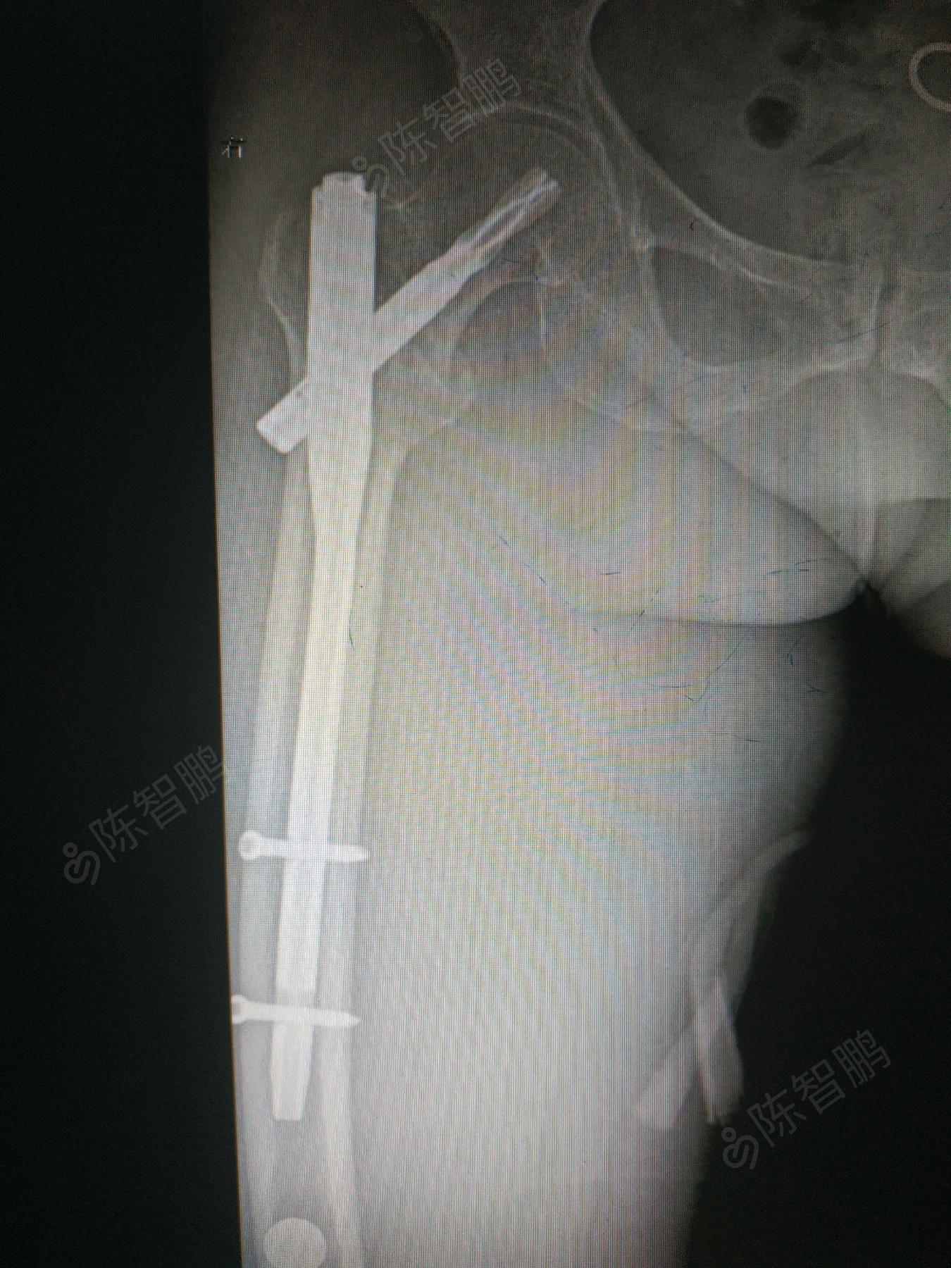 右股骨粗隆间骨折闭合复位pfna内固定术