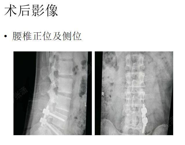 腰椎单边固定 tilf治疗腰椎间盘突出症