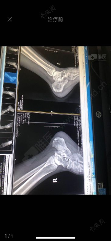 实验室及器械检查 x-ray双侧跟骨多处骨小梁及骨皮质连绩性中断表现