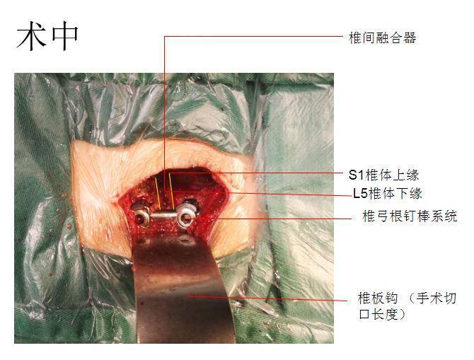 确定责任节段,行"腰椎后路椎管减压植骨融合单边内固定术,术后指导