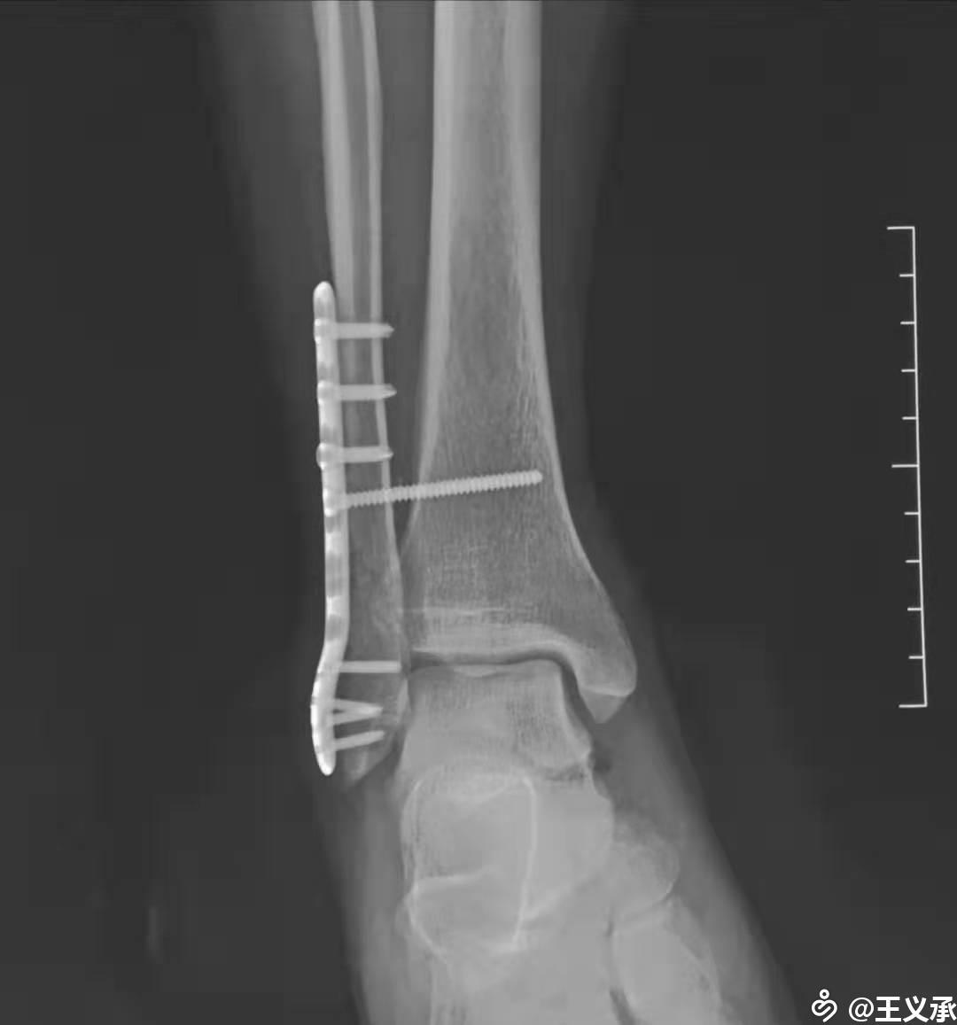 外踝骨折伴下胫腓前韧带断裂的治疗一例