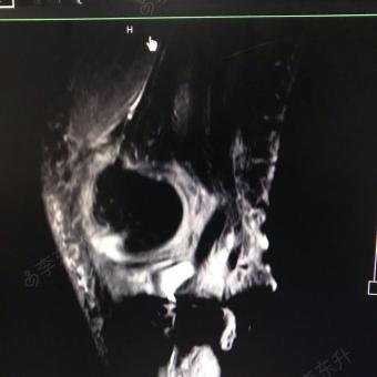 应部平坦,无胃型肠型蠕动波,腹式呼吸存在,无腹壁静脉曲张,手术疤痕
