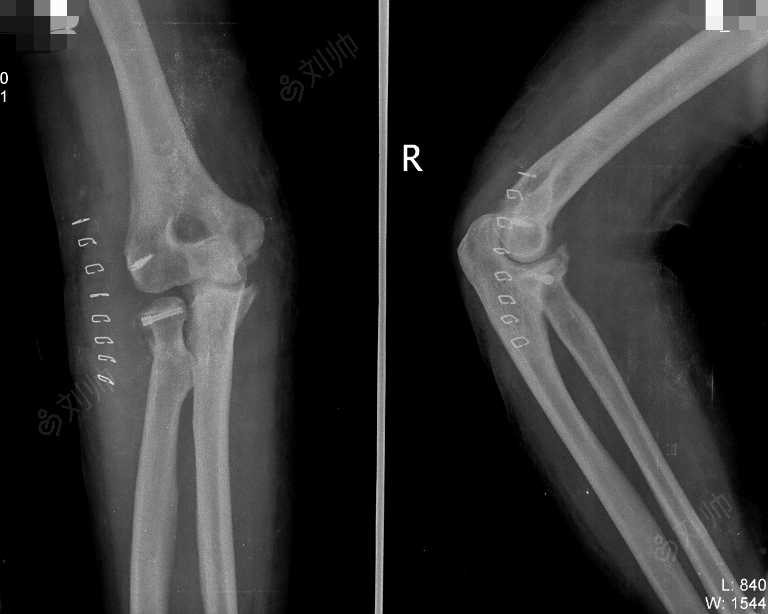 右肘关节脱位伴桡骨小头,冠状突粉碎性骨折