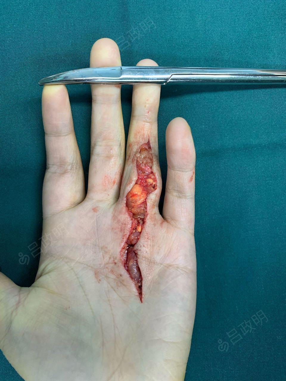 左环指腱鞘巨细胞瘤