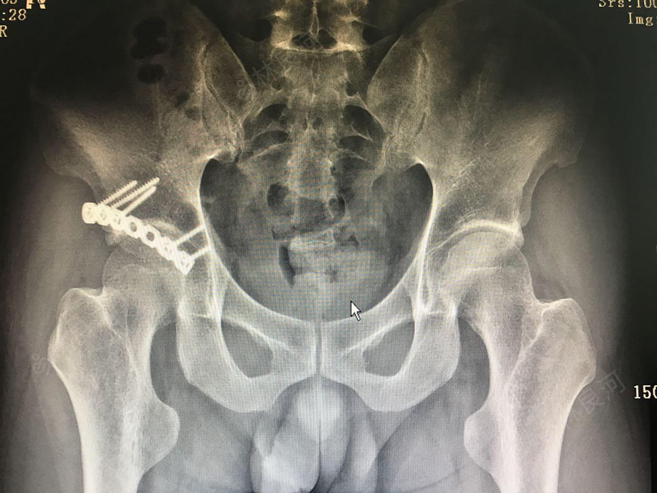 手术记录 1,右髋臼骨折切开复位内固定术 取左侧卧位,取右髋后外侧