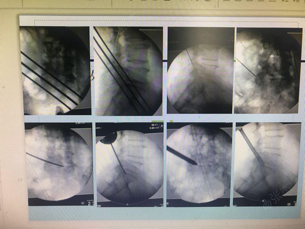 腰椎间盘突出症(艾瑞昔布 镇痛)