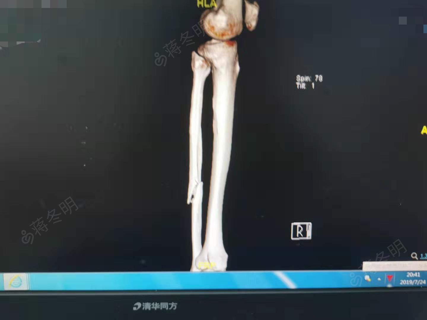 左腓骨骨折一例