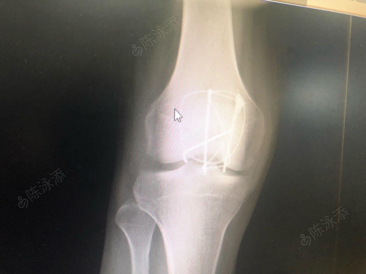 手术记录 1,右髌骨骨折切开复位内固定术 膝关节腔清理术 产品信息