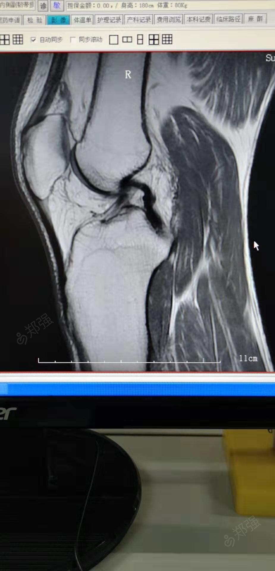 右膝关节前十字韧带损伤,右膝关节内侧副韧带损伤症