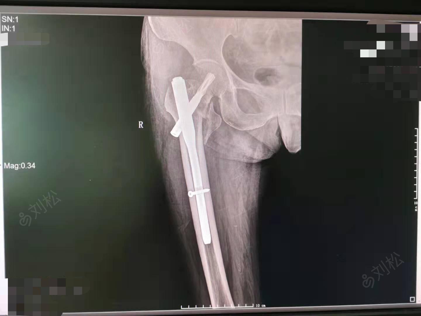 右股骨粗隆间粉碎性骨折