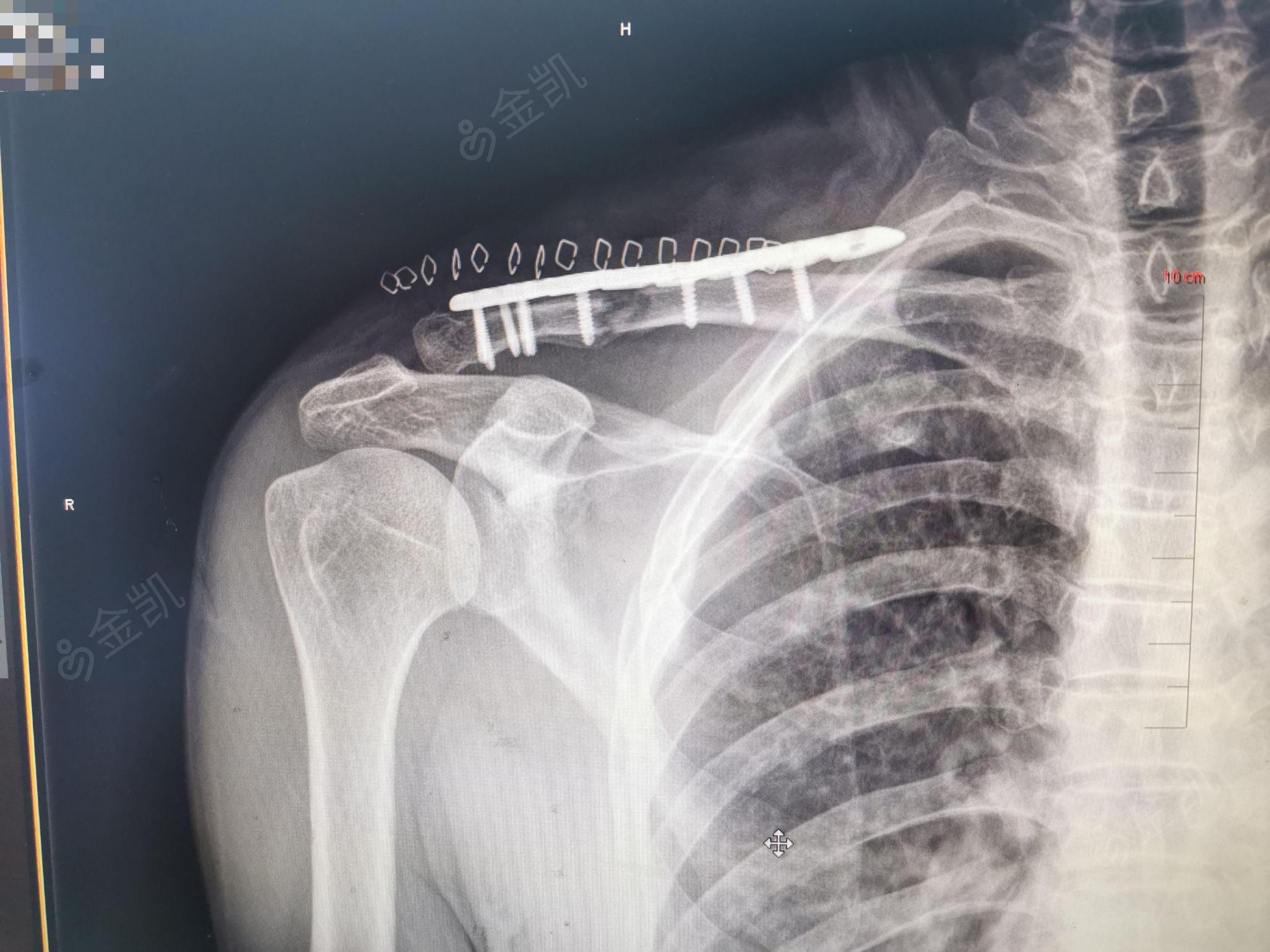 右锁骨骨折切开复位钢板内固定术