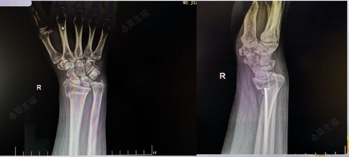 右桡骨远端陈旧性骨折