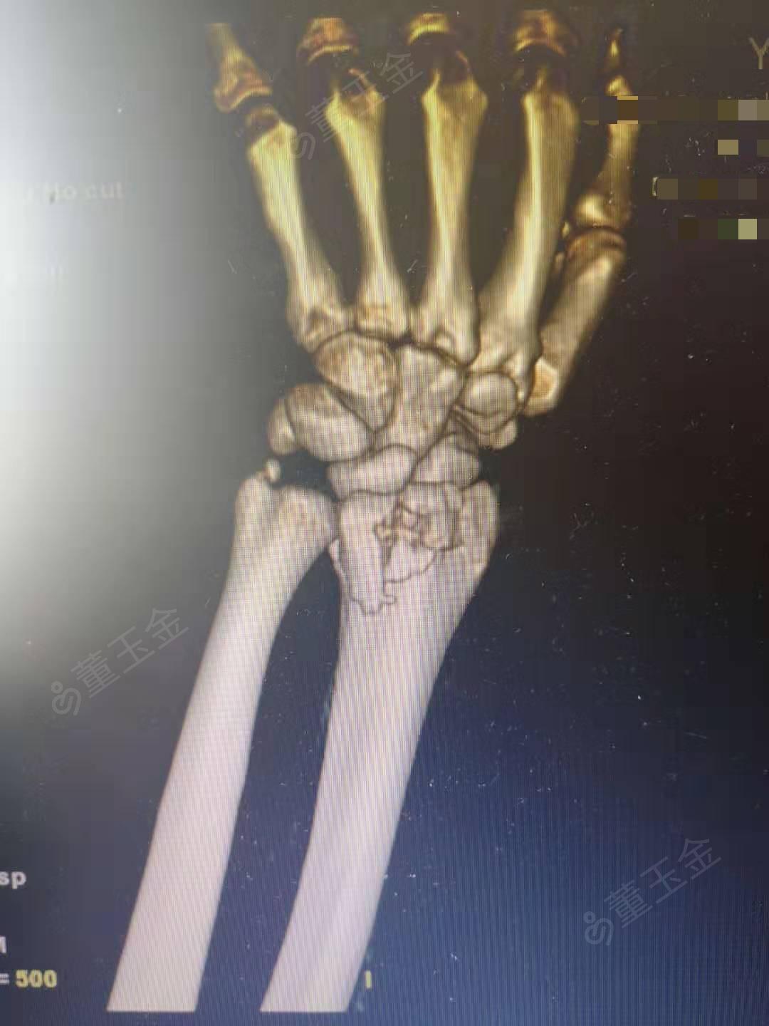 左桡骨远端骨折