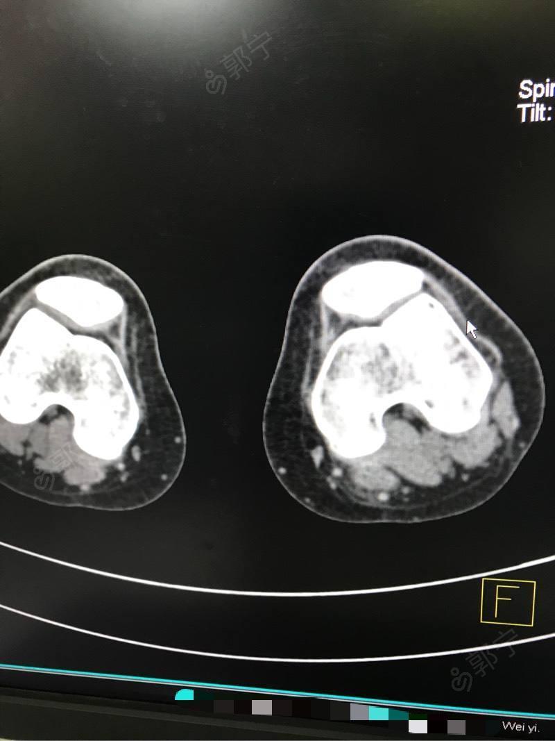 鉴别诊断 :1,恶性肿瘤:边界不清楚,质硬,压痛( ),无波动,有静脉怒张.
