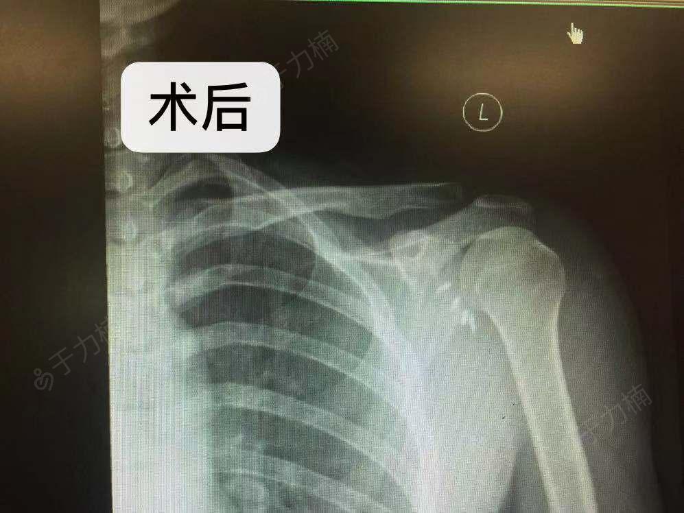 左肩关节盂唇损伤的手术治疗