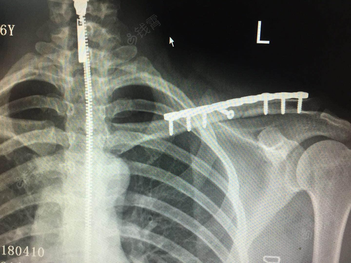 1,锁骨骨折切开复位钢板内固定术 1,患者麻醉成功后,取仰卧位,左肩垫