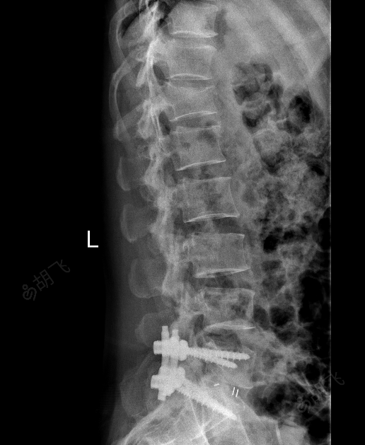 胸12椎体爆裂性骨折