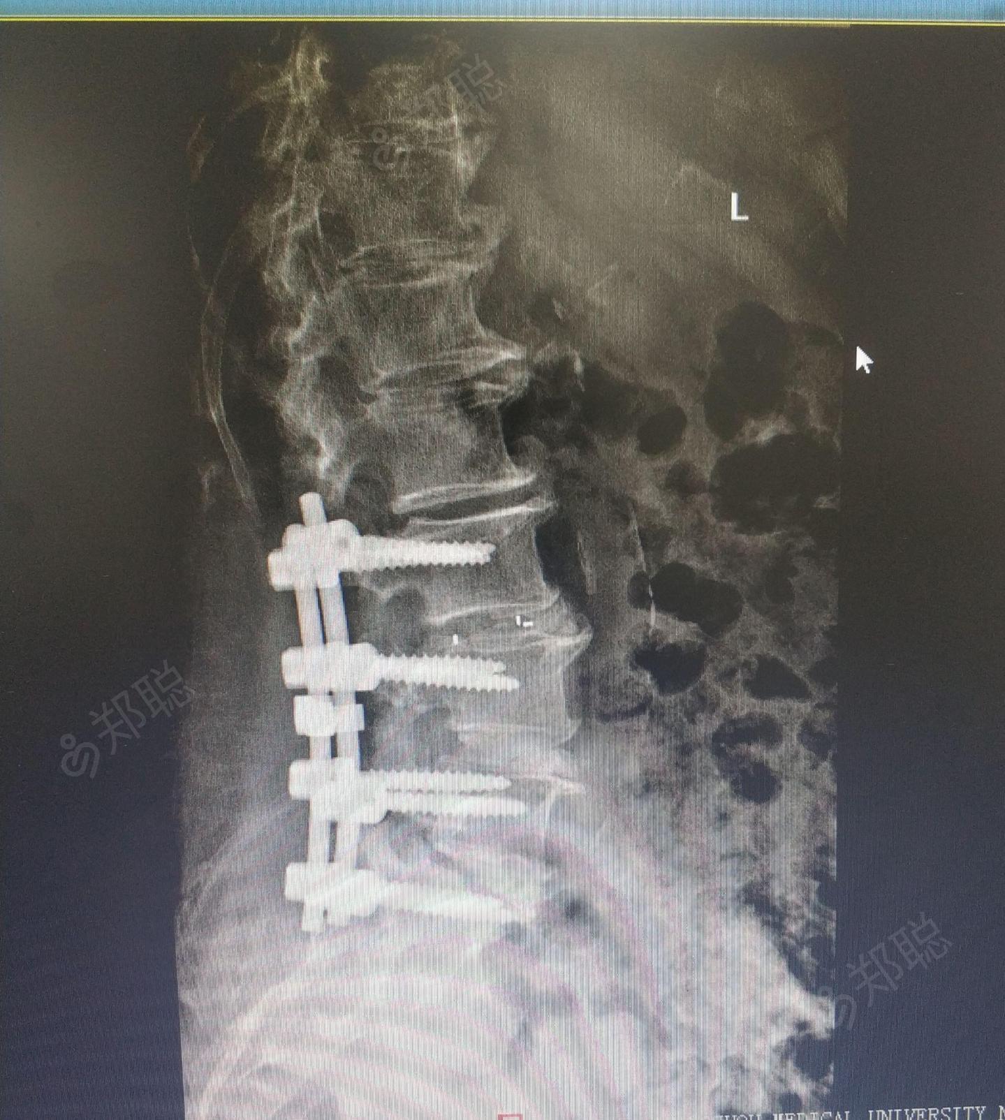 腰椎椎管狭窄症