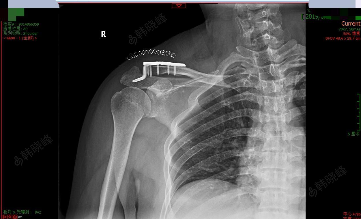 右肩锁关节脱位切开复位内固定术
