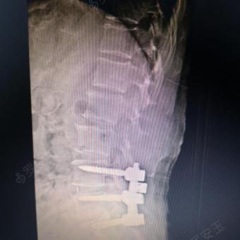 l5/s1椎间盘摘除椎间融合椎弓根钉内固定术