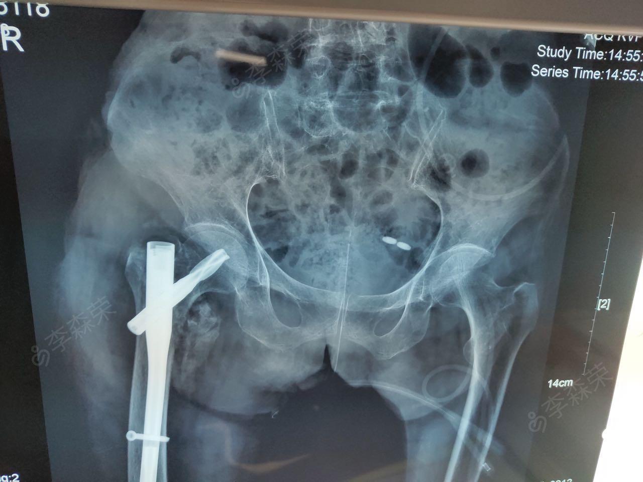 右股骨粗隆间骨折闭合复位pfna内固定术