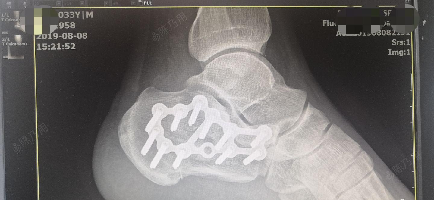 左跟骨粉碎性骨折切开复位内固定术