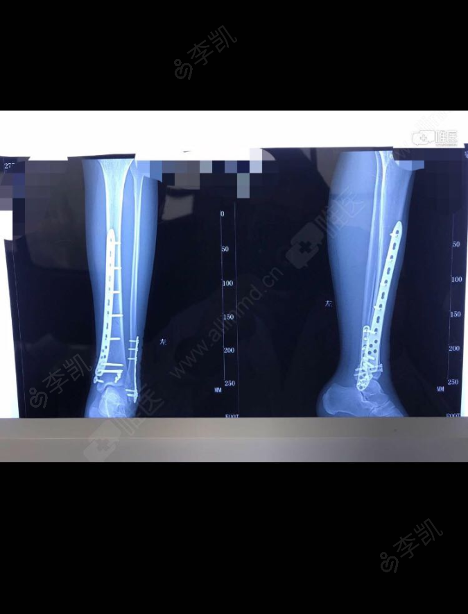 左胫骨粉碎性骨折 左外踝骨折复位内固定