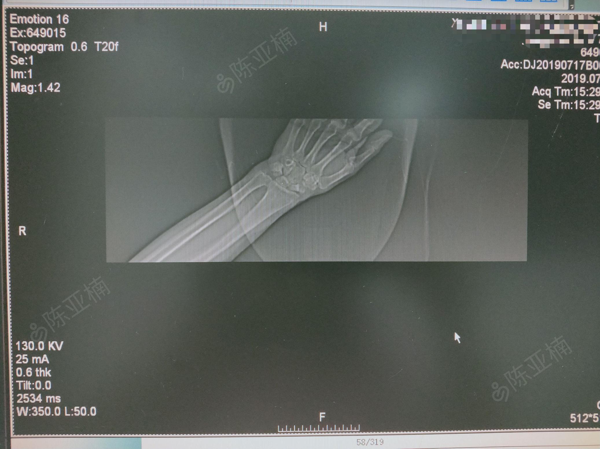 右腕部肿胀,桡骨茎突,尺骨茎突压痛明显,可触及骨擦感,腕关节活动障碍