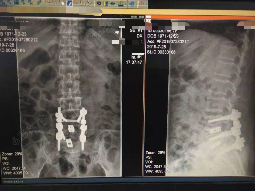 产品信息 无 康复计划 患者卧床体息,避免过度弯腰及提重物,防止跌跤