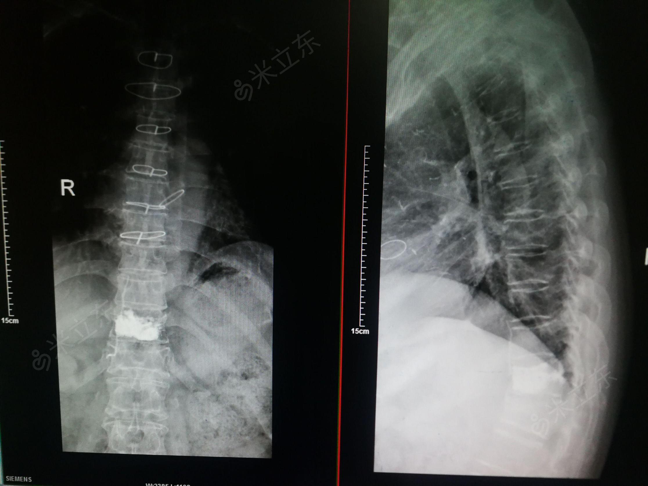 胸11椎体压缩性骨折