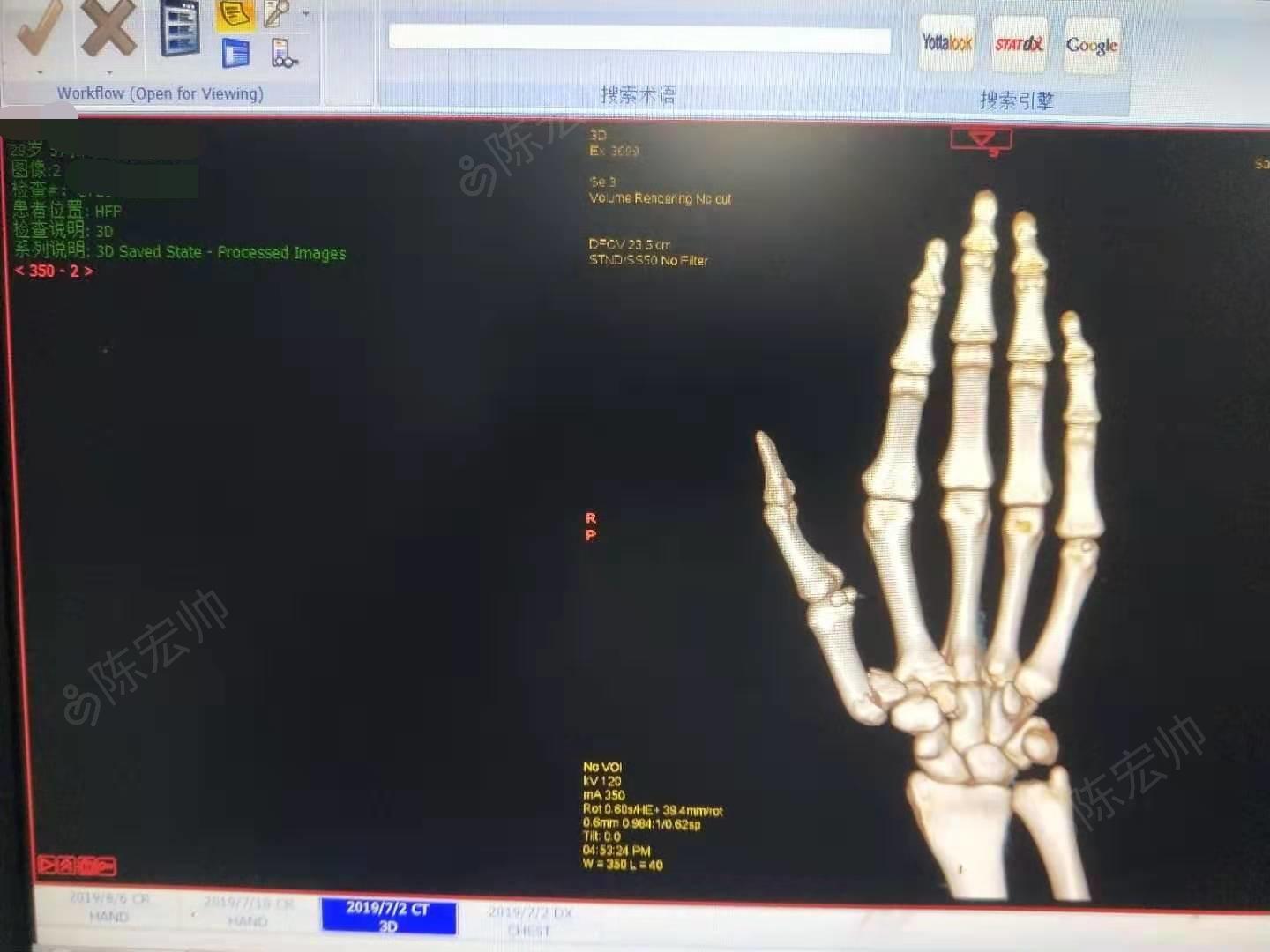 左手第一掌骨骨折