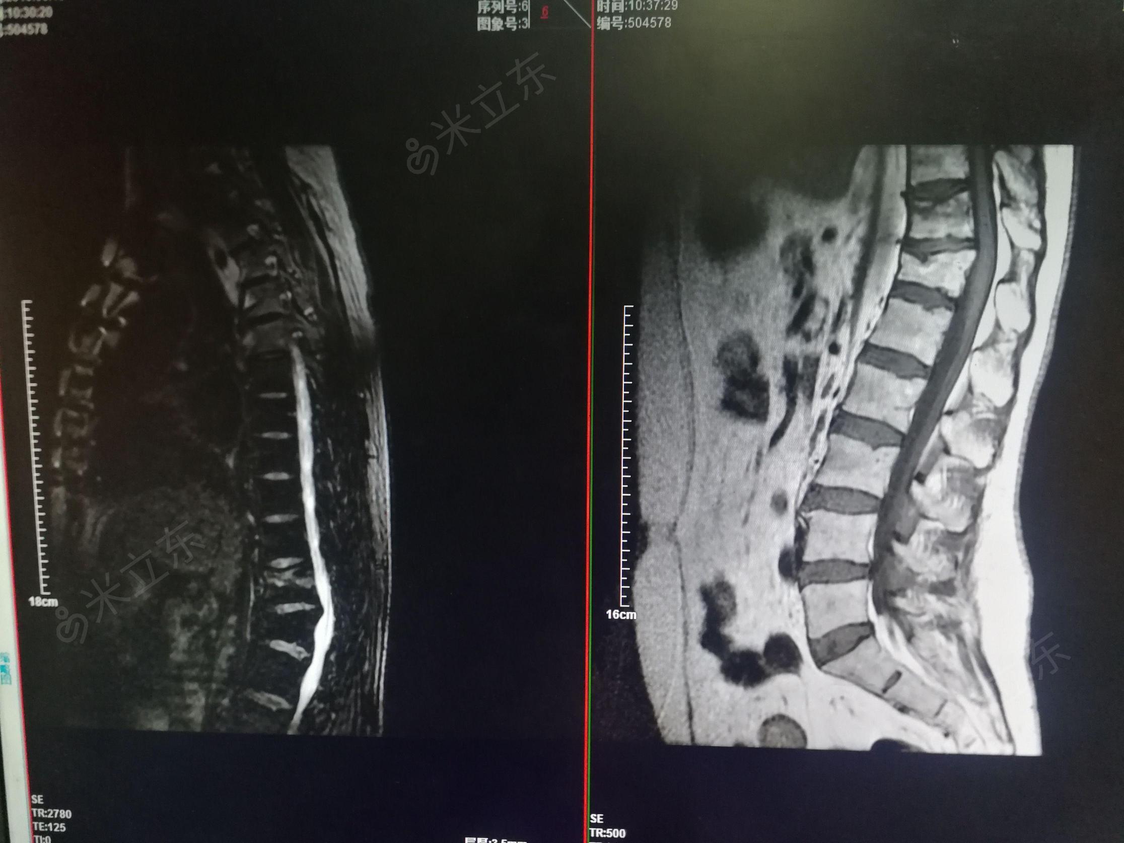 胸11椎体压缩性骨折