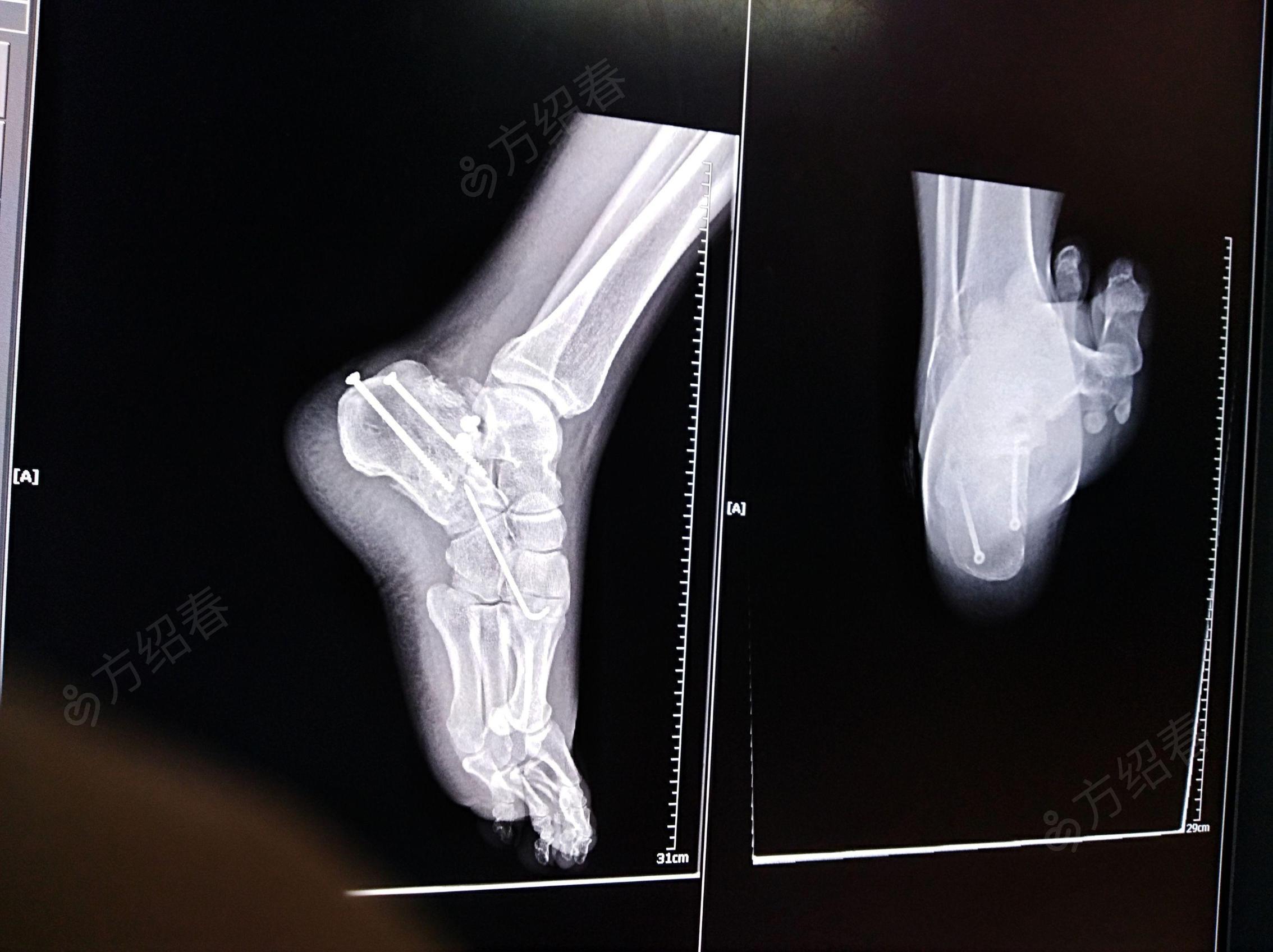 右跟骨粉碎性骨折切开复位内固定