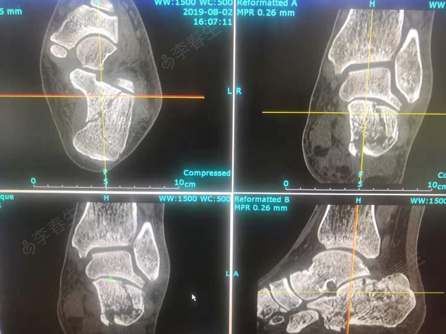 左跟骨粉碎性骨折