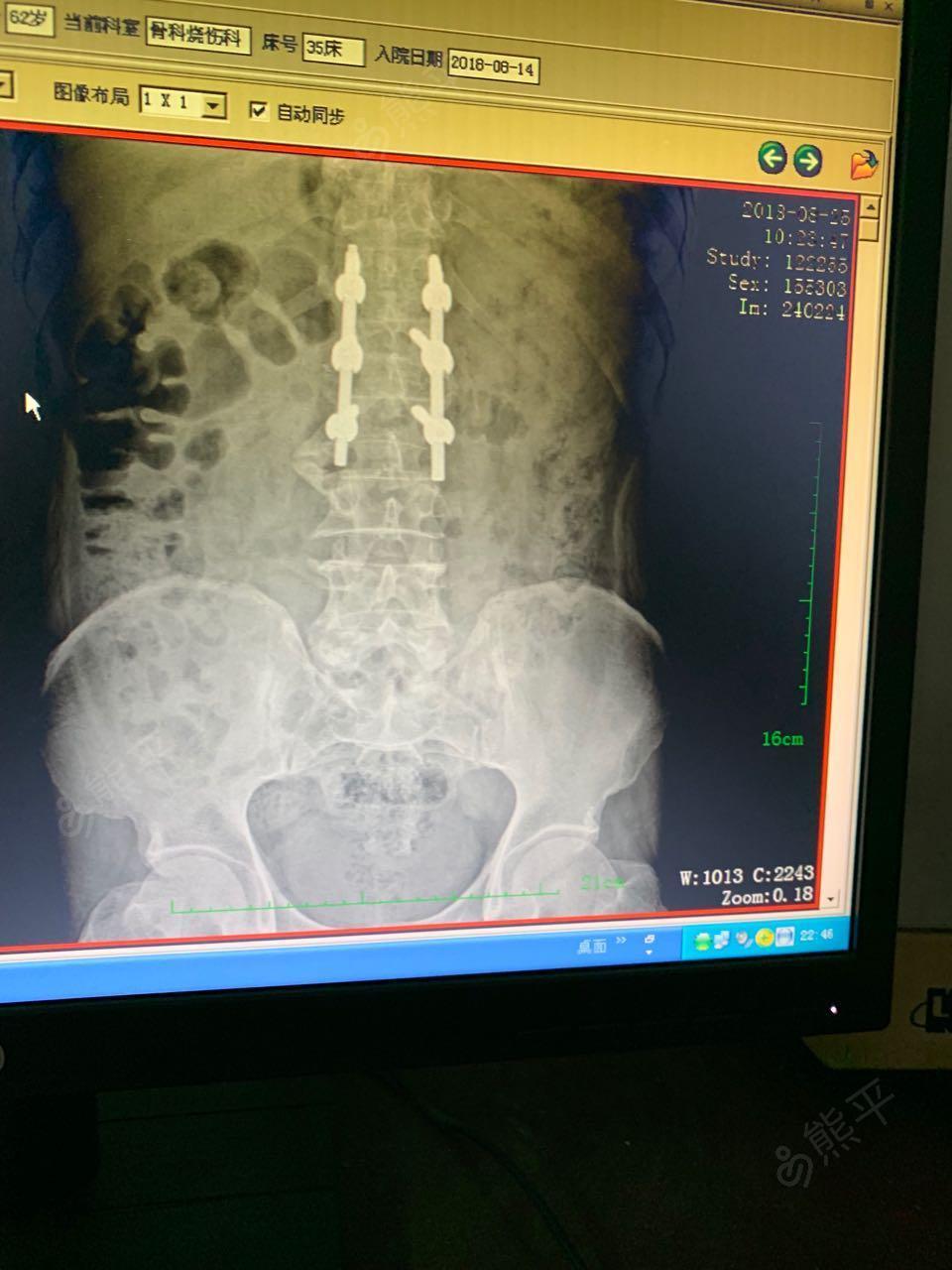 腰1椎体骨折后路切开复位钉棒系统内固定术