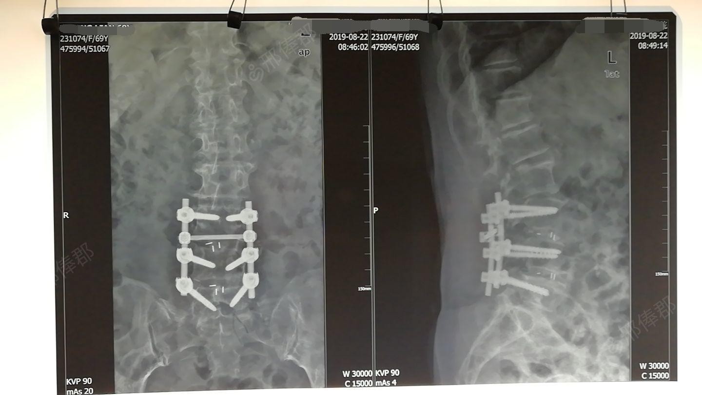 腰3-5椎间盘突出髓核拆除,椎间植骨融合内固定术