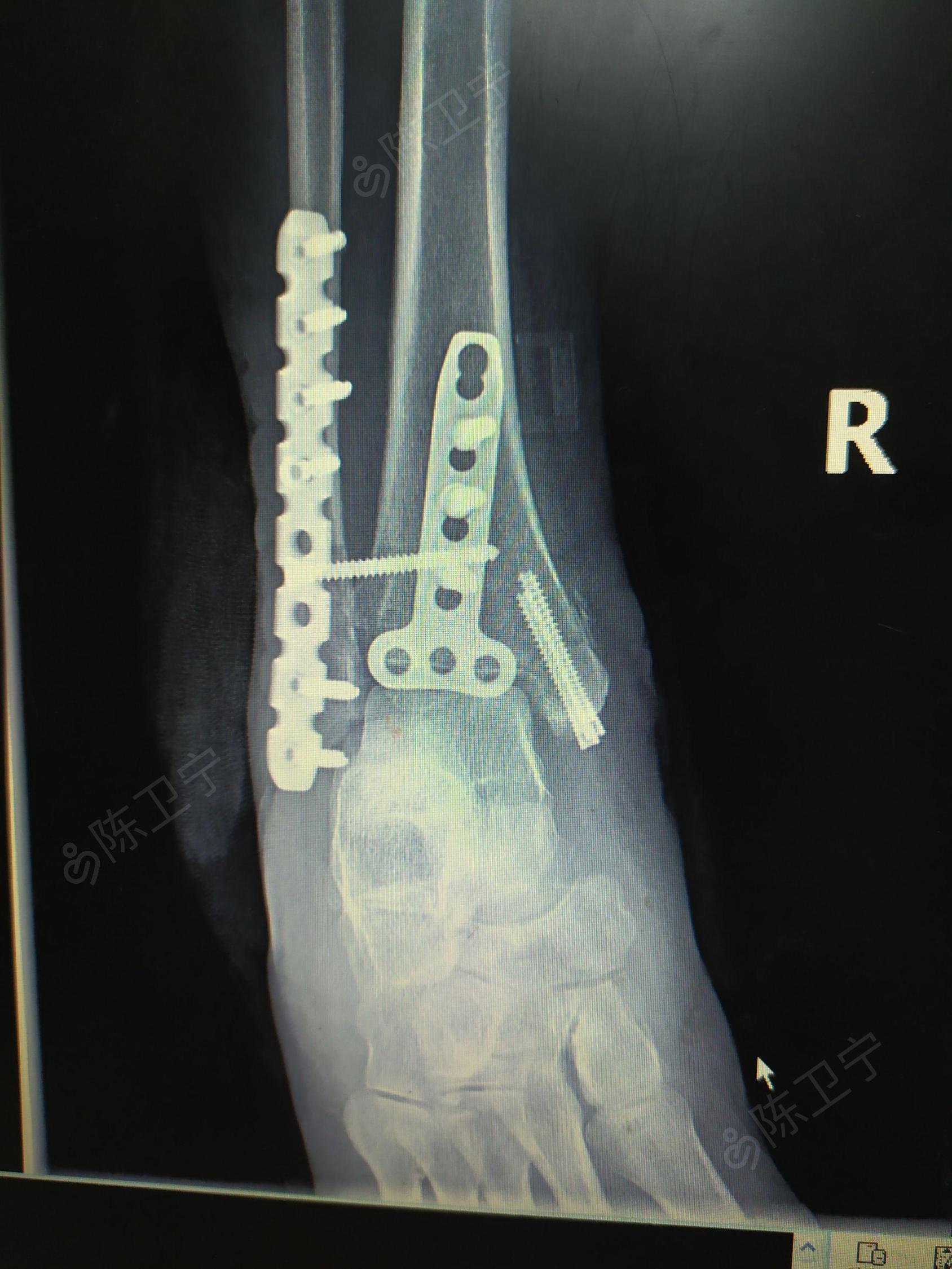 在深圳，做右脚踝距腓前韧带断裂修复手术记录哈哈（巨详细） - 知乎