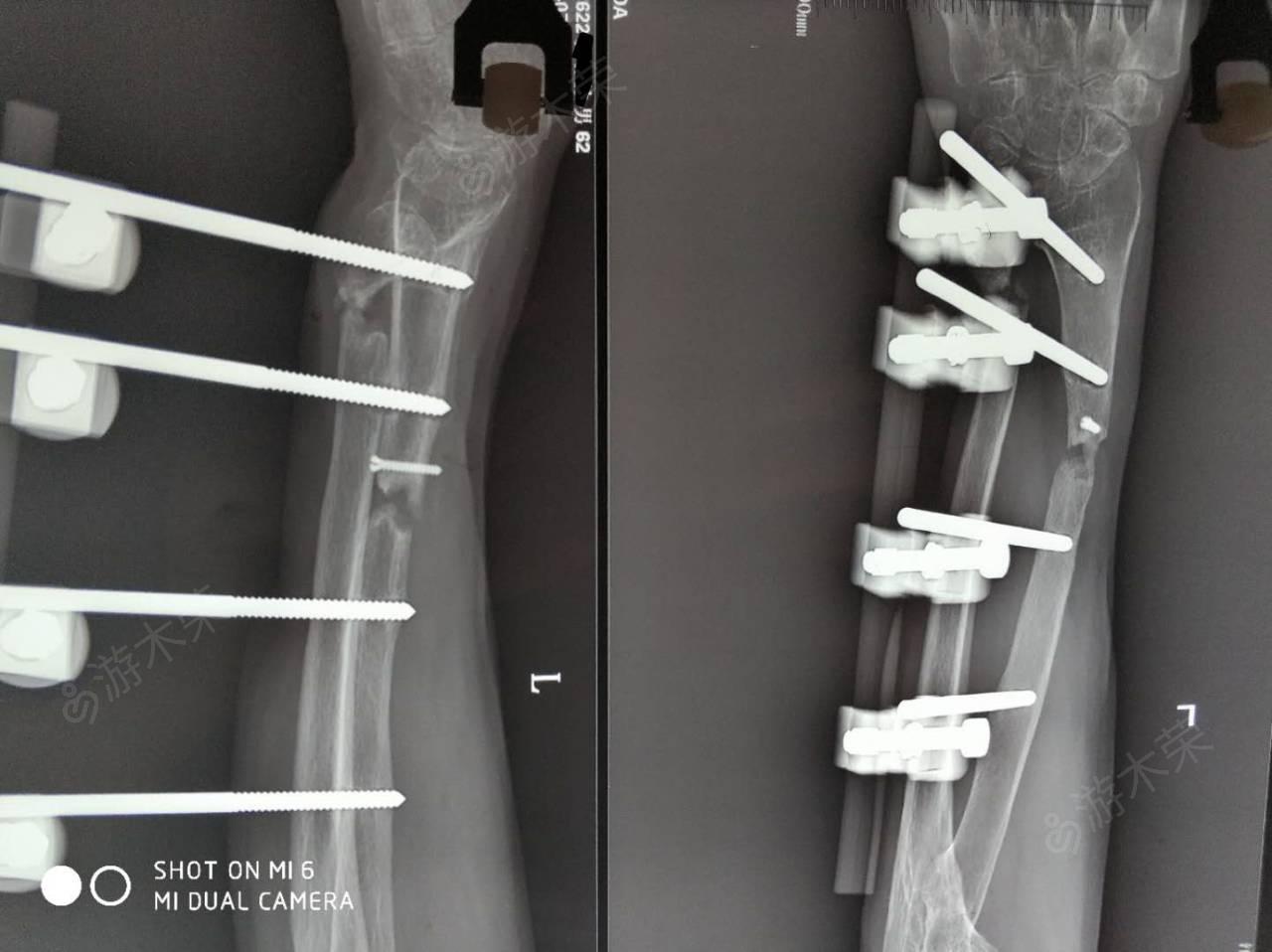 逆行髓内钉微创治疗32C2型股骨干骨折 - 微医（挂号网）