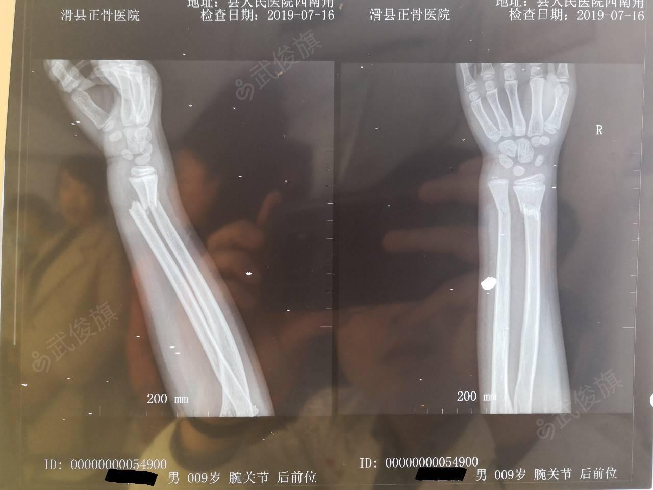 手腕|严重畸形18年手腕重获新生 假体系上海微创自主研发 手术|异种|re|基因编辑|猪心脏