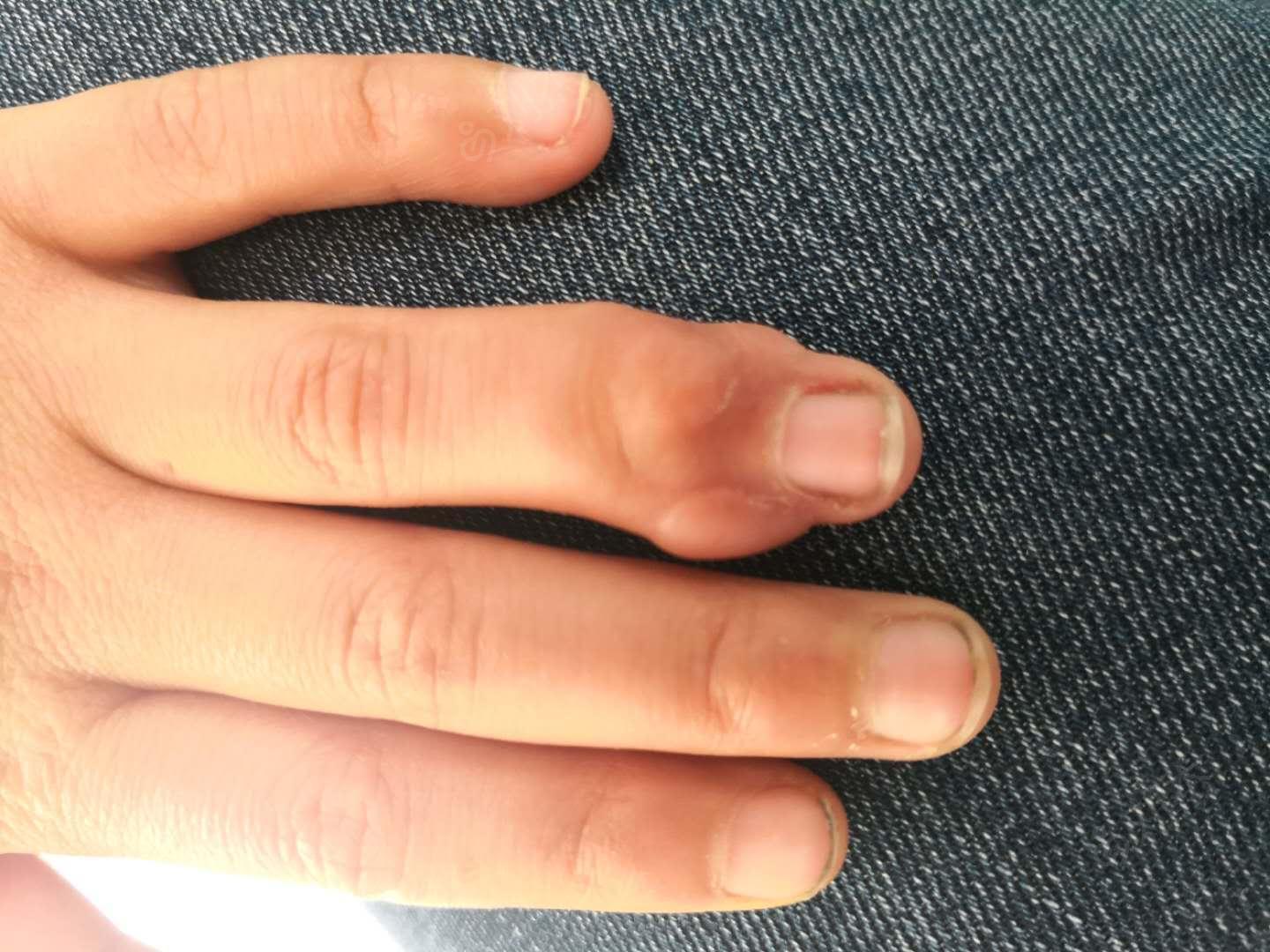 六岁儿童手指多发硬性结节请教诊断