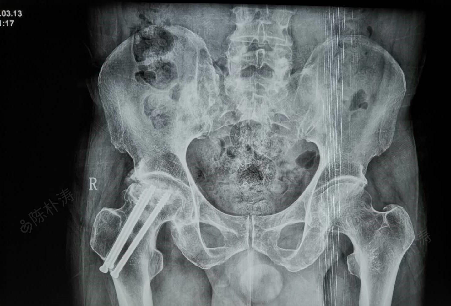 股骨颈骨折术后股骨头坏死