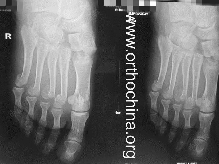 右足2-5跖骨头骨折1-3楔骨 骰骨骨折治疗