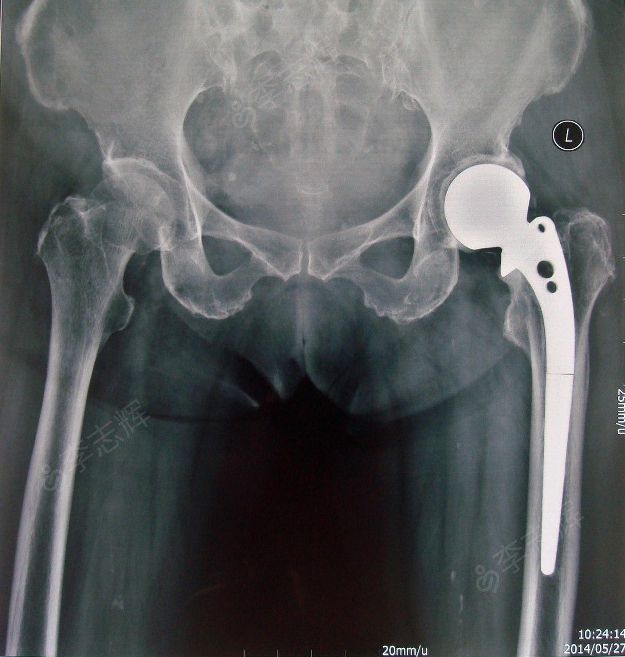 女,76岁,左股骨颈骨折半髋置换术后,传统moore骨水泥假体柄断裂