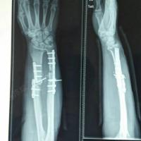 男,45岁,尺桡骨粉碎性骨折术后桡骨钢板断裂