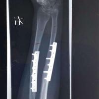 右尺桡骨骨折及桡骨小头骨折术后疼痛的治疗