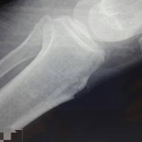 男69岁,胫骨结节炎